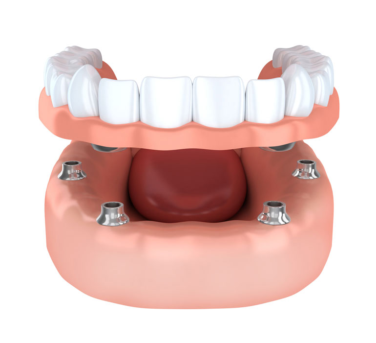 Implantate, Feste Zähne an einem Tag